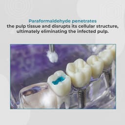 Prime Dental DeVitex Pulp Devitalising Paste - 6