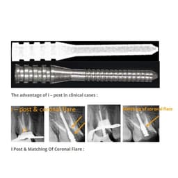 Prime Dental iPost (Endo Metal Post) - Integrated Endodontics #3