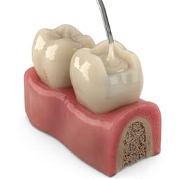 Prime Dental Restorite Ionomer Flow Composite - 6