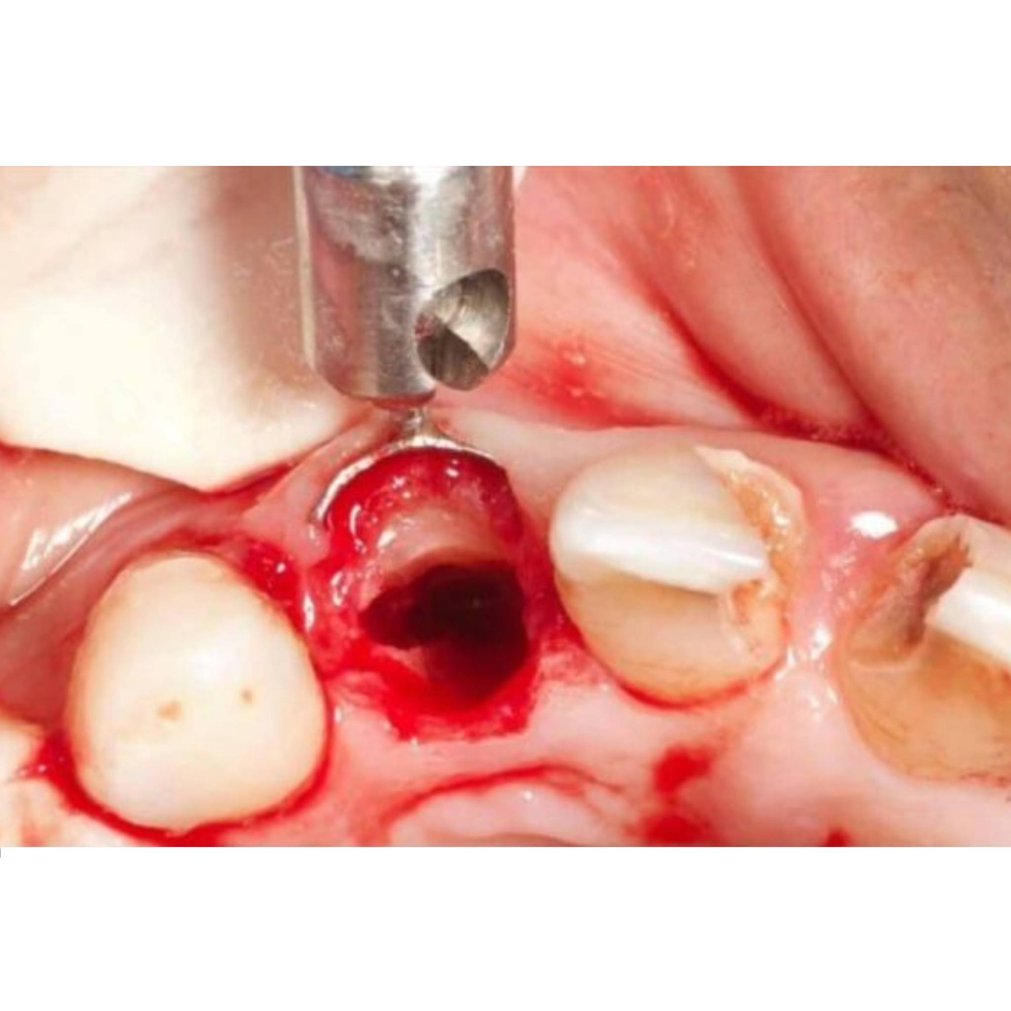 Julldent Dual Cheek & Flap Retractor