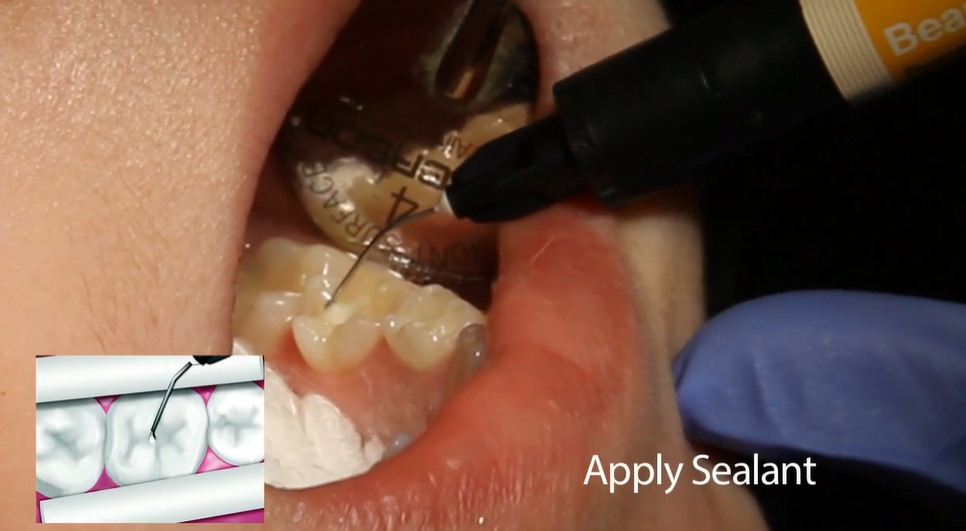 Shofu BeautiSealant Complete Set