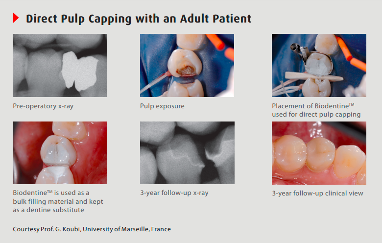 Septodont Biodentine Kit (Pack of 5 capsules) (Short Expiry 09-2026)