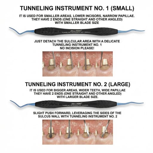 Julldent Soft Tissue Vista Tunneling Kit (JULL-DENT 182)
