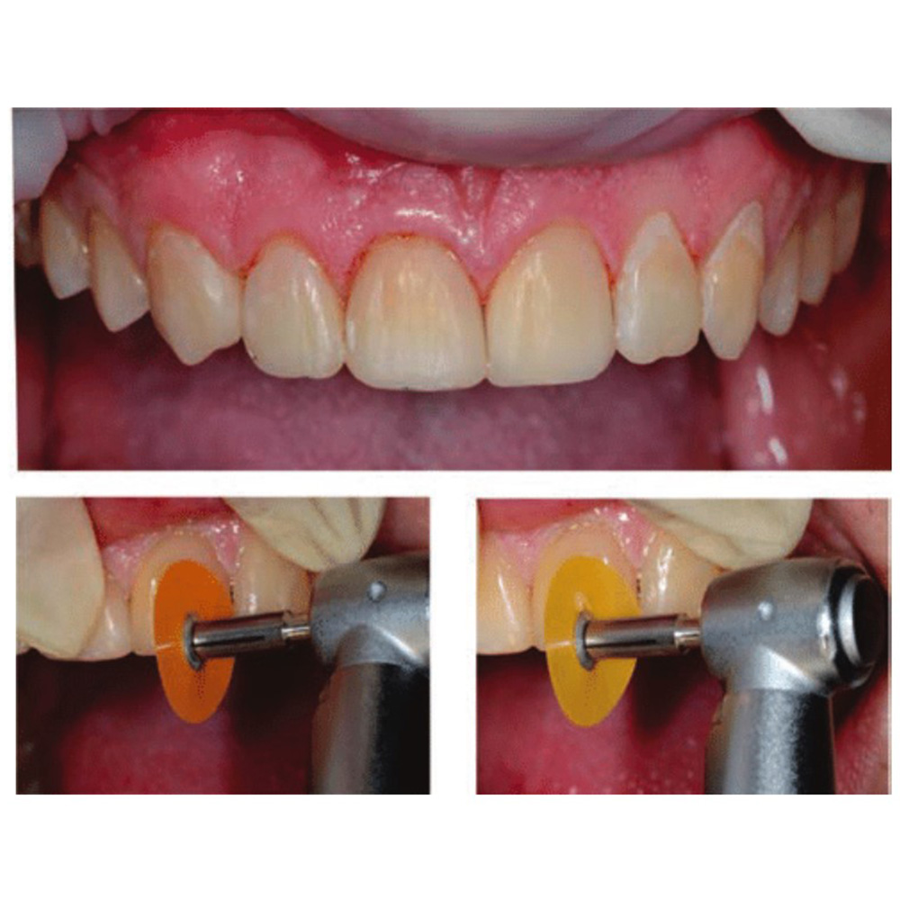 3M ESPE Sof-Lex Extra Thin Polishing Discs Intro Kit