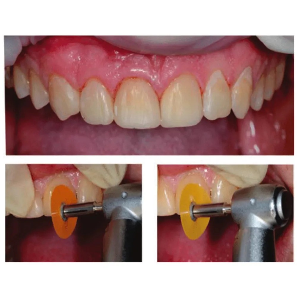 3M ESPE Sof-Lex XT Extra Thin Polishing Discs (Pack Of 30)