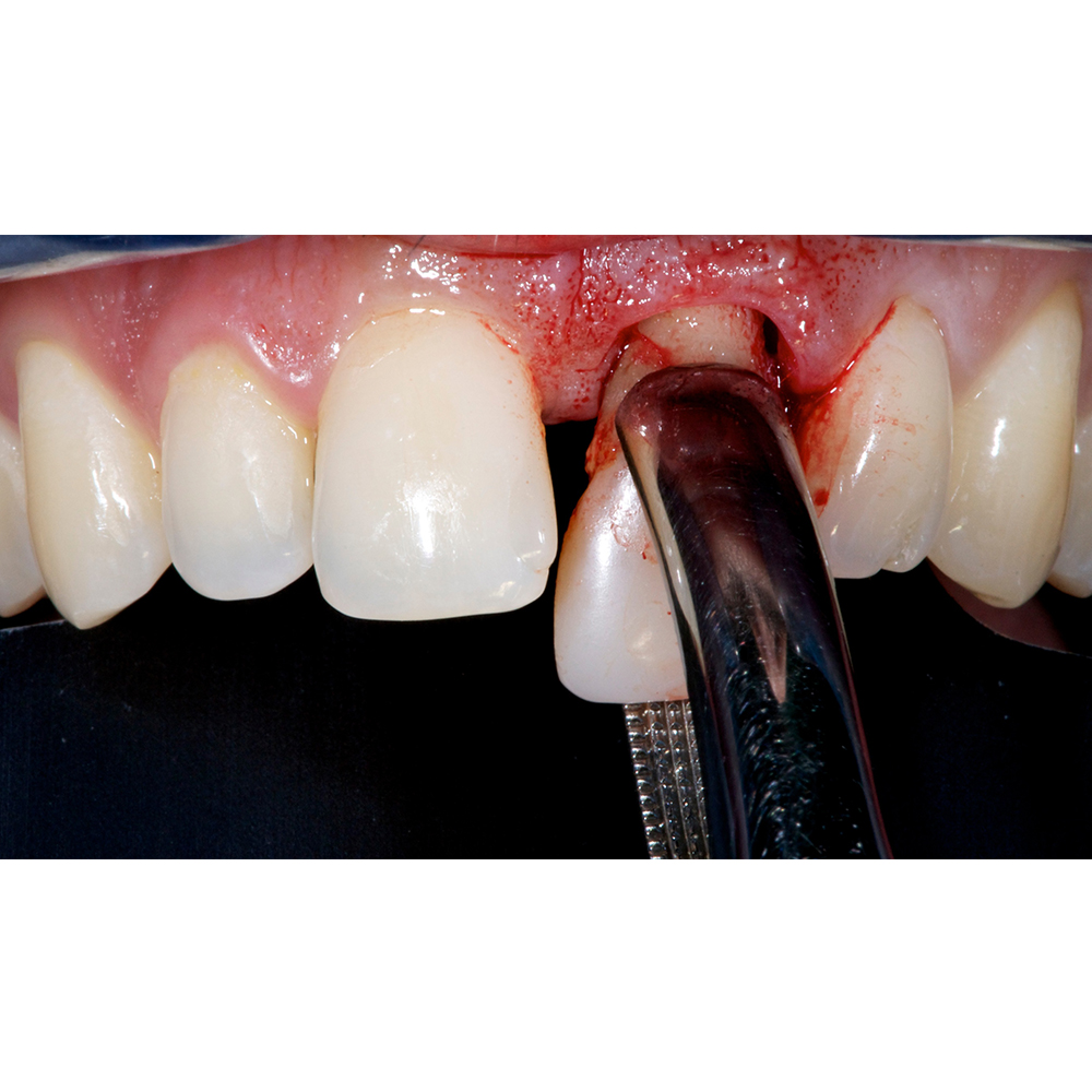 GDC Extraction Forceps Lower Anteriors And Roots - 74 Standard (FX74S)