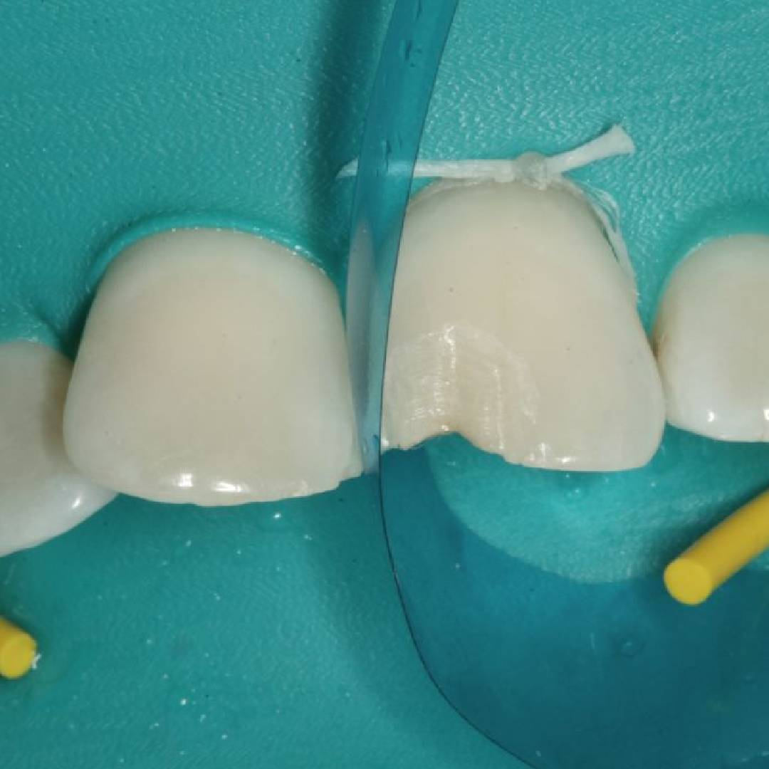 ET Dental Matrix Strips - Straight