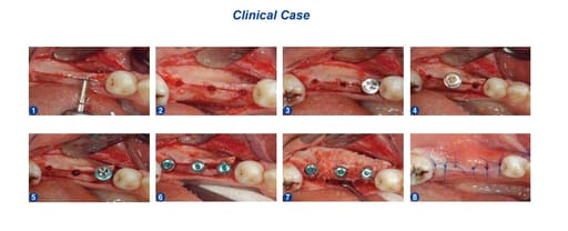 Surgident Bone Expander Kit for Narrow Ridge (SD-BE)