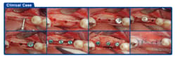 Surgident Bone Multi System - Combined Expander & Spreading Kit (SD-BMS) - 11