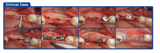 Surgident Bone Multi System - Combined Expander & Spreading Kit (SD-BMS)