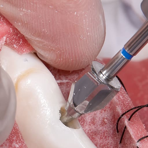 Surgident Bone Profiler Kit (SD-BP)