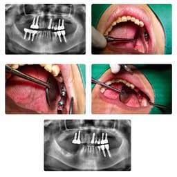 Surgident Fixture Remover Kit (SD-FR) - 7
