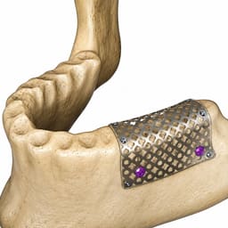 Surgident GBR Bone Tacs (Pack of 5) - 8