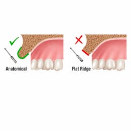 Surgident Ridge Contouring Bur Kit (RCBS) - 6