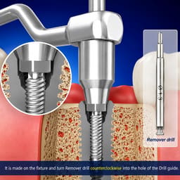 Surgident Screw Remover Kit (SD-SR) - 8