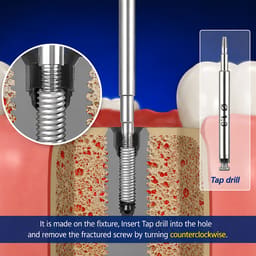 Surgident Screw Remover Kit (SD-SR) - 10