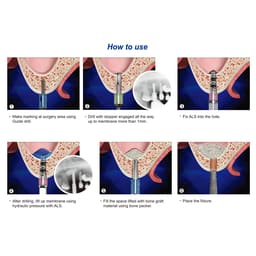 Surgident Aqua TOCA Kit for Crestal Sinus Lift with Hydraulic System (SD-AQUA) - 13
