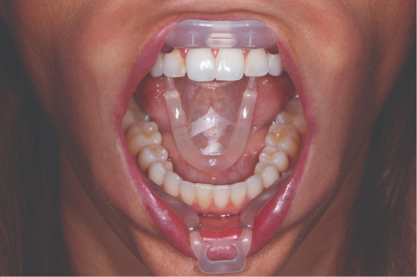 Ultradent Umbrella Tongue, Lip And Cheek Retractors (Pack Of 5)