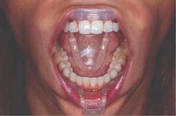 Ultradent Umbrella Tongue, Lip And Cheek Retractors (Pack Of 5) - 6