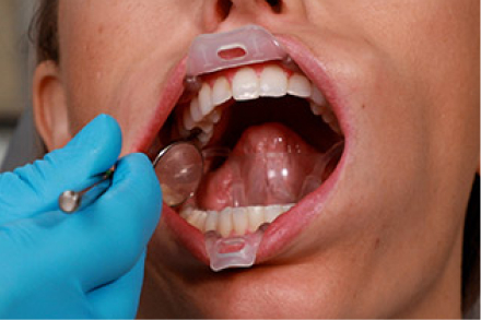 Ultradent Umbrella Tongue, Lip And Cheek Retractors (Pack Of 5)