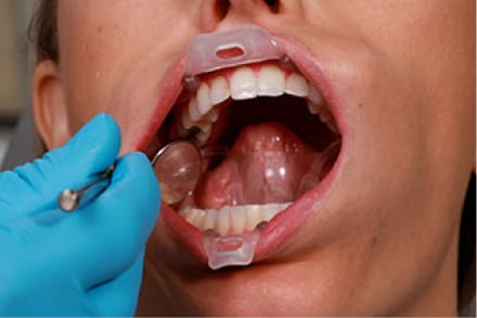 Ultradent Umbrella Tongue, Lip And Cheek Retractors (Pack Of 5)