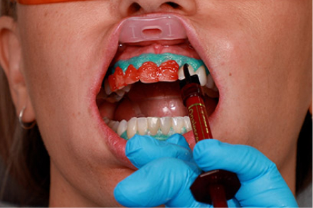 Ultradent Umbrella Tongue, Lip And Cheek Retractors (Pack Of 5)