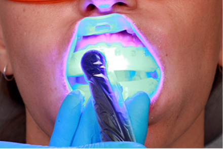 Ultradent Umbrella Tongue, Lip And Cheek Retractors (Pack Of 5)