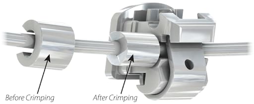 OrthoMetric SS Orthodontic Stops