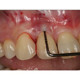 Julldent Periodontal Files (JULL-DENT 192) - 3