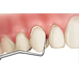 Julldent Periodontal Files (JULL-DENT 192) - 4
