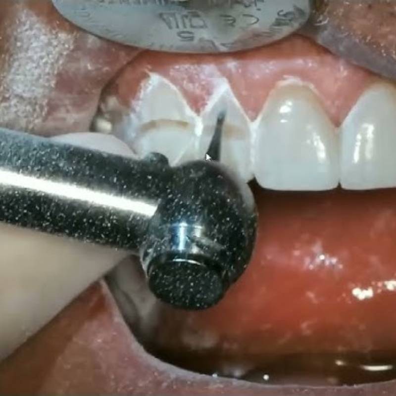 MIK All-in-One Laminate/Veneer Tooth Preparation Bur Kit