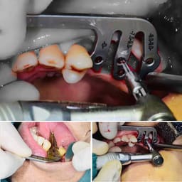 Waldent Dental Implant Guide Set (K19/15) - 7