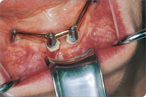 Waldent Minnesota Retractor with Suction Tube (8/143)