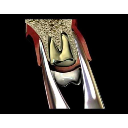 Waldent Tooth Extraction Forceps Upper Roots No. 76N (1/121)