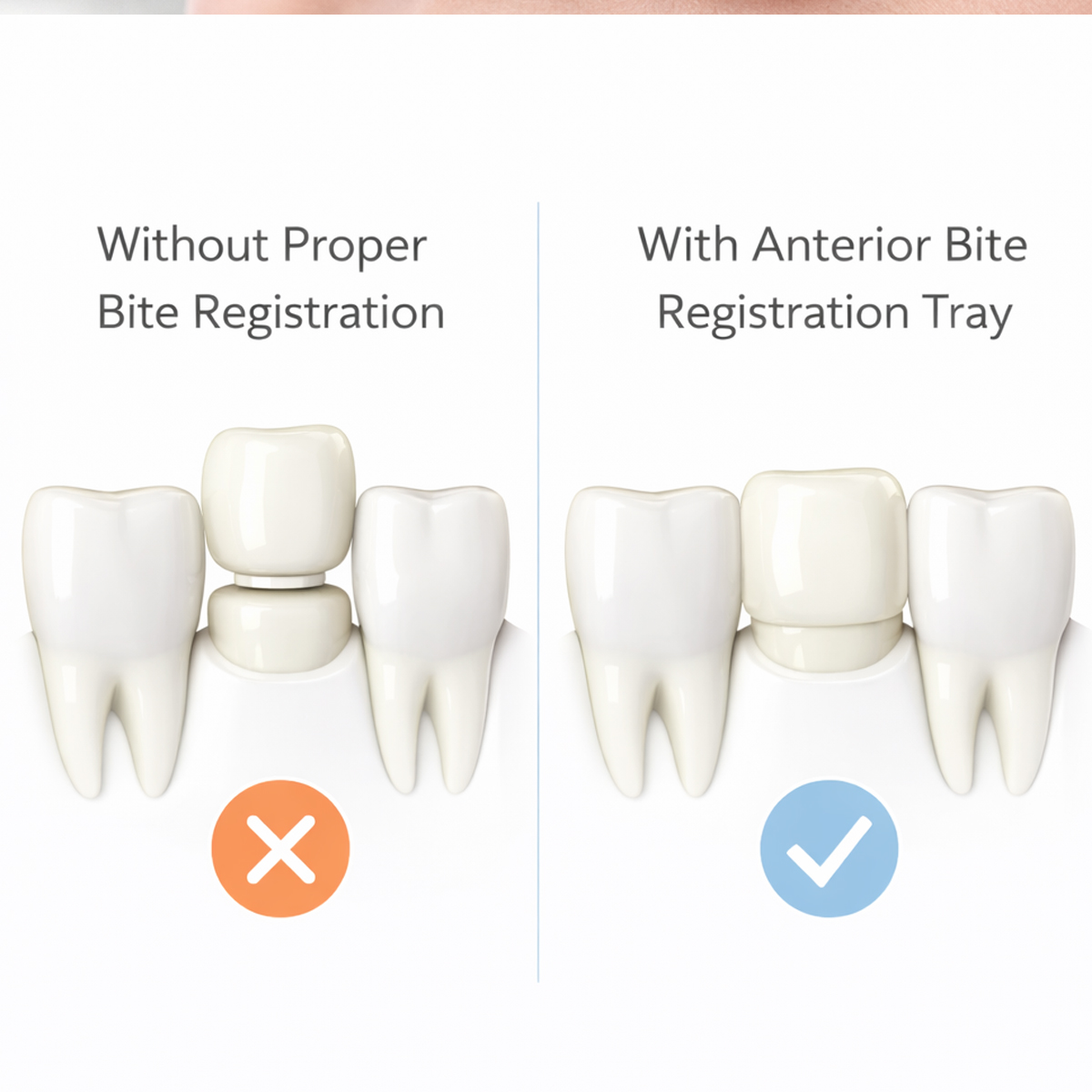 Oro Bite Registration Trays - Anterior