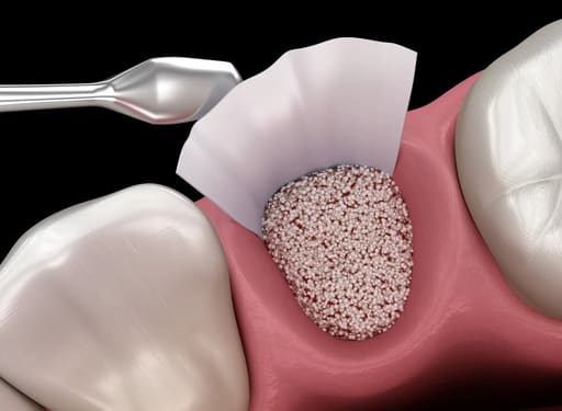 B-Ostin TP Bonegraft Materials 0.500 - 1.000mm