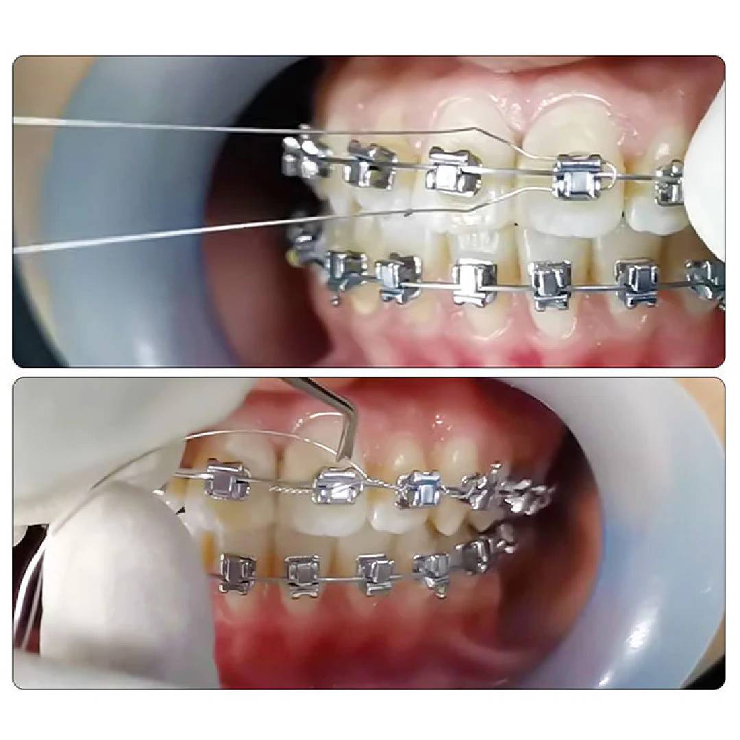 UU Ortho Preformed Ligature Wire 15.5cm (Pack of 100)