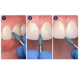 Youdent Composite Interproximal & Margin Refinement Kit FG - GF032 | Green Flame Shaped (Pack of 12) - 8