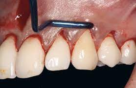 Waldent Vista Tunneling Procedure Kit Set of 6 (K22/1)