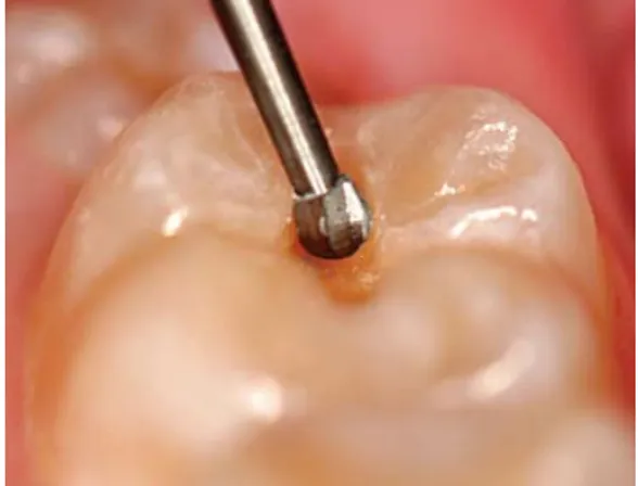 Prima Dental Round Straight Handpiece Carbide Bur (Set of 5)