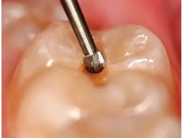 Prima Dental Endodontic Access Kit