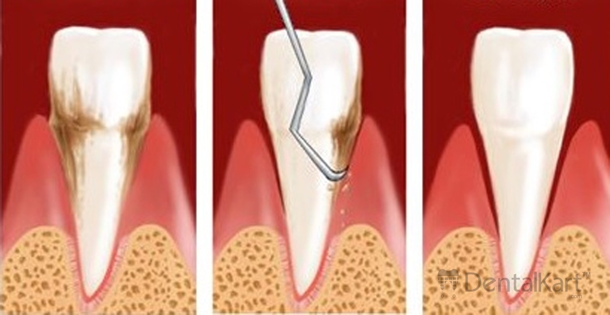 Waldent Gracey Curettes Set of 7 