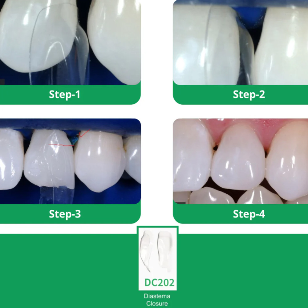 Bioclear Diastema Matrix Closure Series