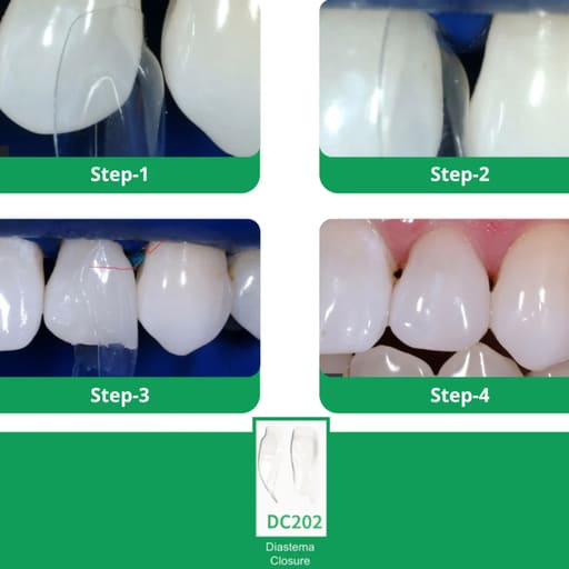 Bioclear Diastema Matrix Closure Series