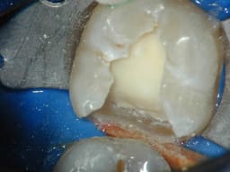 Medicept Dental Hydrocal LC (Calcium Hydroxide + Barium Sulphate LC) - 8