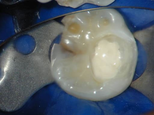 Medicept Dental Hydrocal LC (Calcium Hydroxide + Barium Sulphate LC)