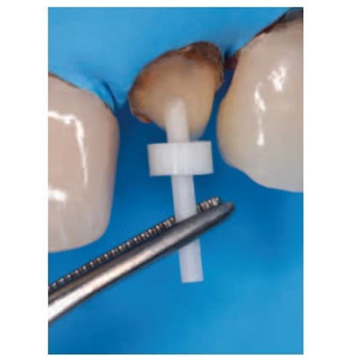 Waldent Radiopaque Composite Fiber Post