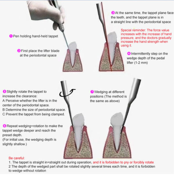 Julldent Sonic Pneumatic Elevator Kit # 204 