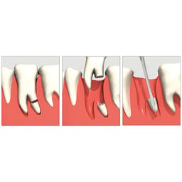 GDC Luxatip - Dual Edge 3mm + 1.5mm (DE3) - 4