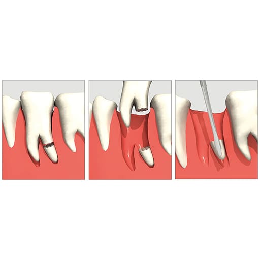 GDC Luxatip - Dual Edge 3mm + 1.5mm (DE3)